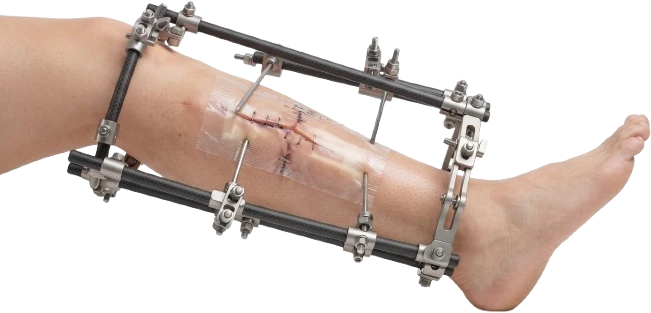 External Fixation Systems